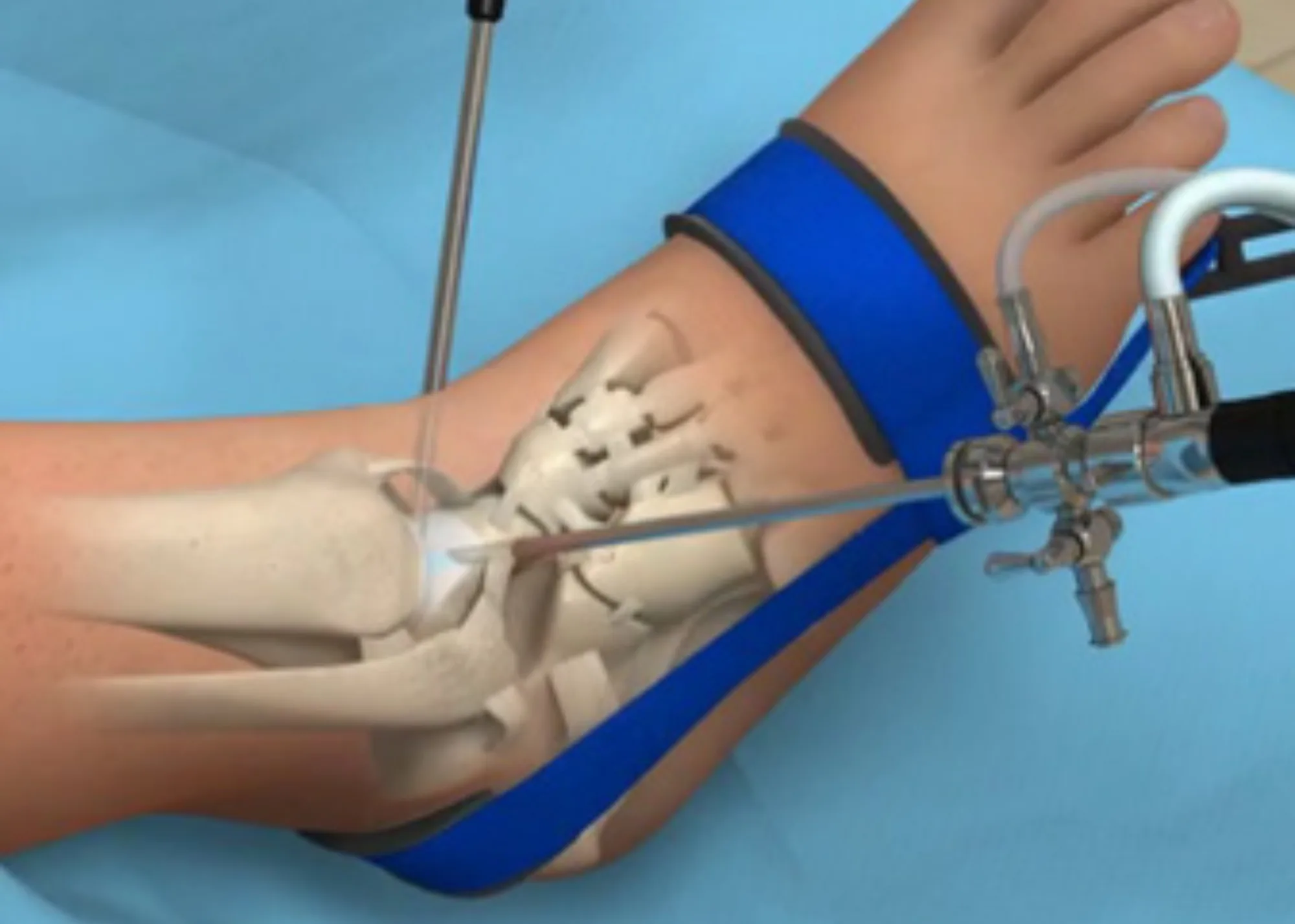 Click for Ankle Athroscopy information & discuss with Dr. Christensen to determine treatment options from North Shore Foot & Ankle located in Appleton, WI.